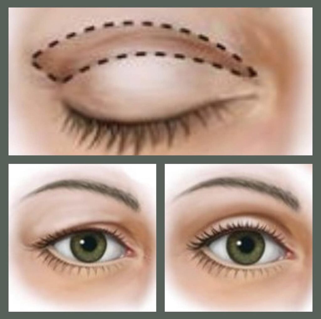 blefaroplastyka w Mielcu
