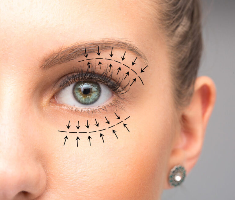 zabieg blepharoplastyki powieki